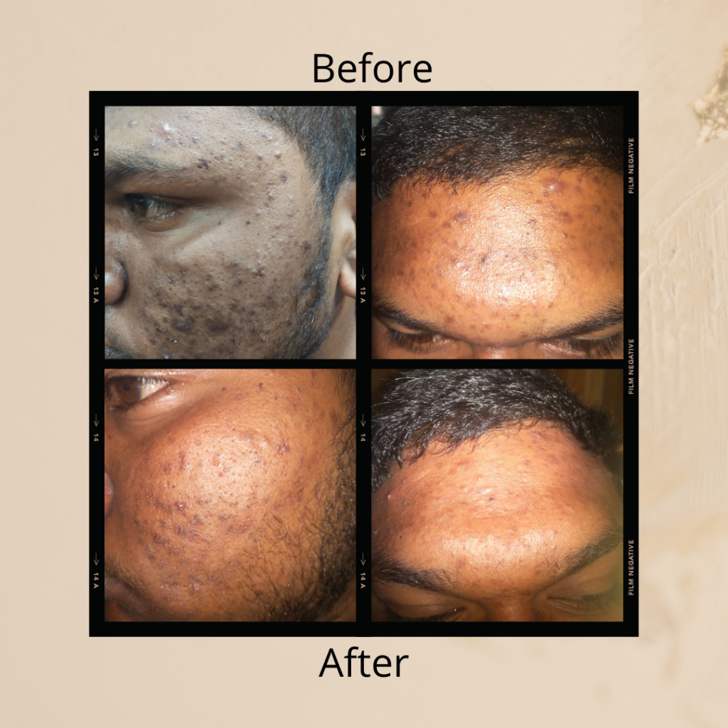 Skin Acne Treatment Surat